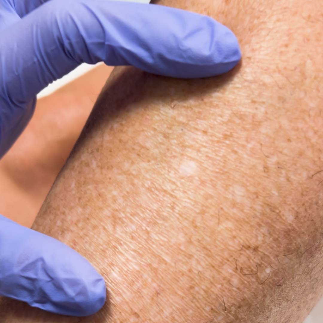 Disidratazione e cera brsiliana